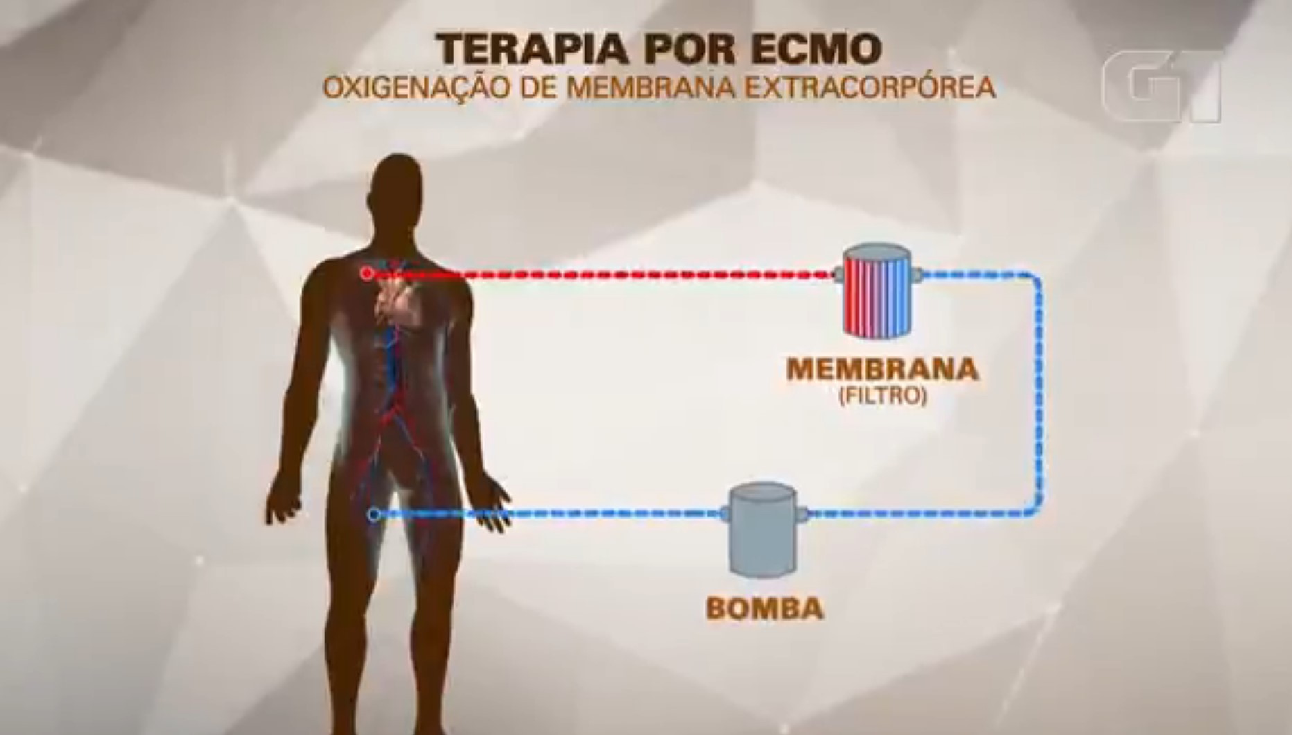 MC Marcinho usa terapia conhecida como ECMO, espécie de pulmão artificial; entenda como funciona